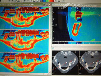 入歯治療　CT撮影