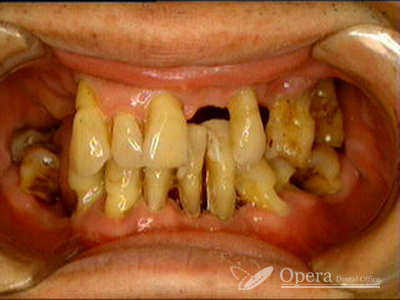 入歯治療　前　歯周病