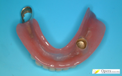 コーヌス実際の入歯
