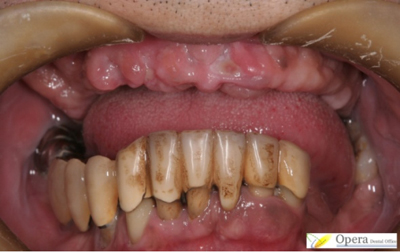 歯周病がひどく、上の歯がまとめて抜けてしまった症例