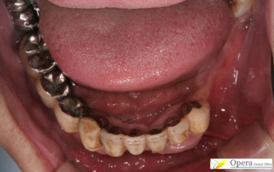 残っている歯が少ない場合の症例